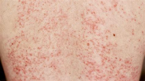What does staph infection look like on skin? - Torrinomedica