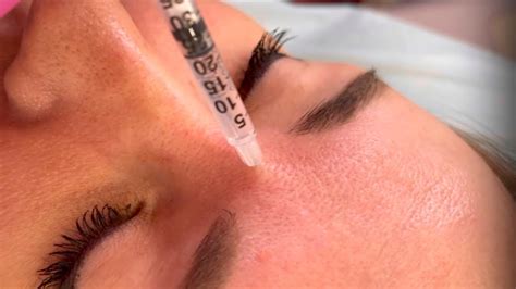 Ботулинотерапия #ботокс #botox #косметология - YouTube