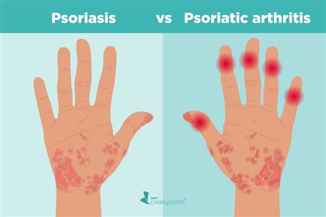 Psoriasis and Psoriatic Arthritis: What’s the Connection?