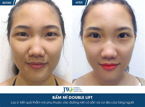 Mắt 2 Mí Là Mắt Như Thế Nào? Bí Quyết Sở Hữu Mắt 2 Mí đẹp Long Lanh