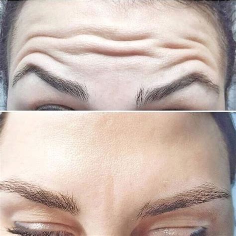 Диспорт Винница | Beauty skin quotes, Skin aesthetics, Facial aesthetics