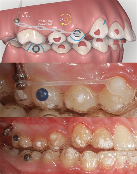 The Biomechanics of Clear Aligners associated with temporary skeletal