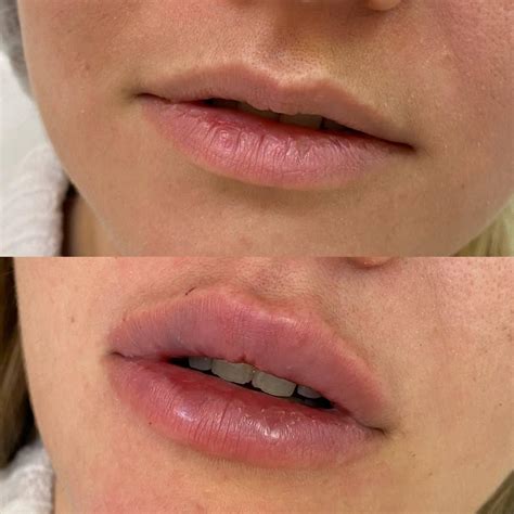 Нитевой лифтинг – Beauty Clinic by Dr. Anita Shvets