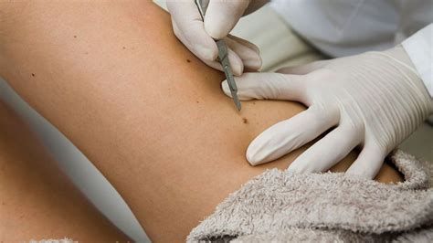 preparing  mohs surgery