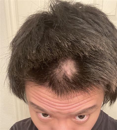 What Causes Bald Spot On Top Of Head - POPULAR MEN'S HAIRCUTS