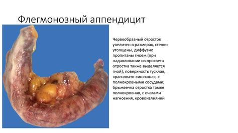 Патанатомия неспецифического язвенного колита, аппендицита ...
