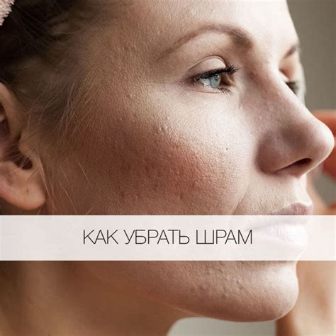 Как убрать шрамы от прыщей на лице: народные домашние средства