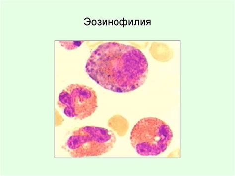 Эозинофилия :: Симптомы, причины, лечение и шифр по МКБ-10.