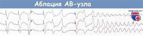 Катетерная радиочастотная аблация атриовентрикулярного узла