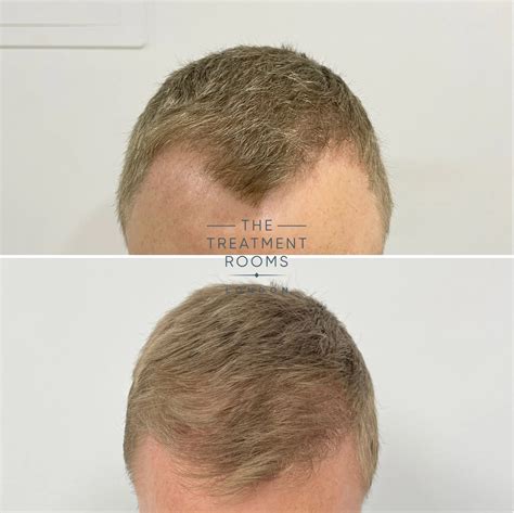 Receding Hairline Stages Signs Treatment What Is An M Shaped Hairline?
