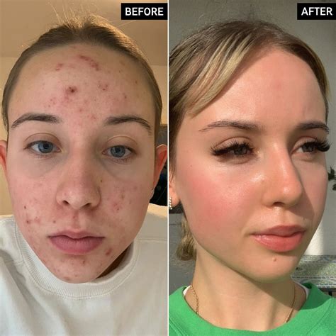 The INKEY List | 2% Tranexamic Acid Serum | Target acne scars