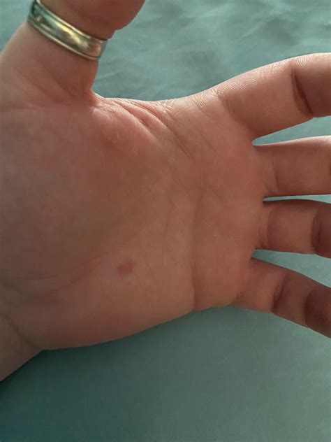 I have a permanent scar on my palm where the bottom left corner of my