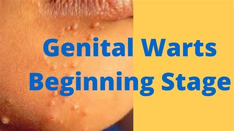 genital warts beginning stage youtube