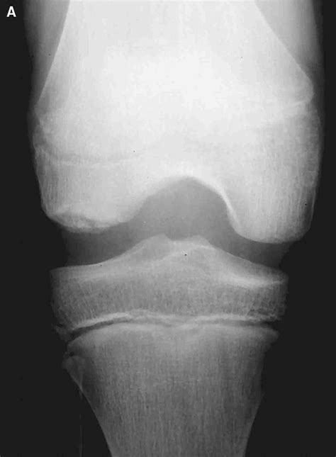 Ask Dr. Hacker: Management of OCD Lesions