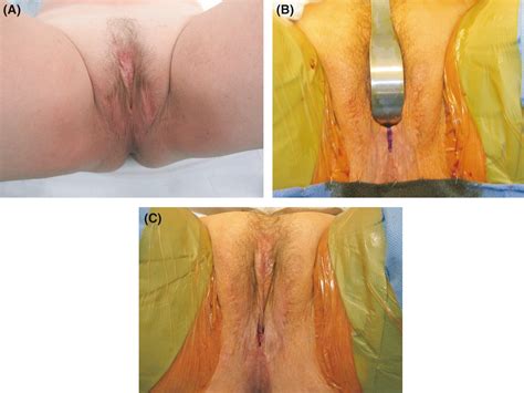 Penile inversion vaginoplasty outcomes: Complications and satisfaction