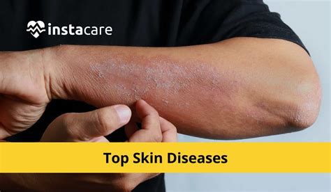 skin disease   douglas nunez blog