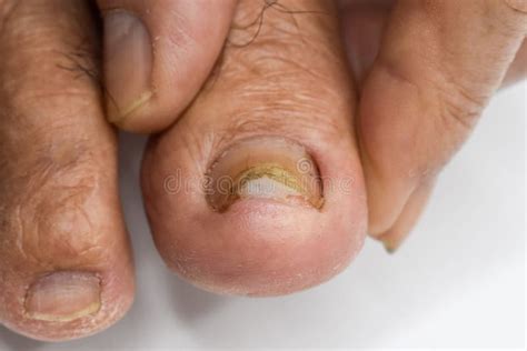 Fungal Nail Infection. Onychomycosis, Also Called Tinea Unguium Stock ...