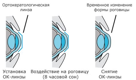 Зрение минус 4: Что это значит, что делать, как видит человек, можно ли ...