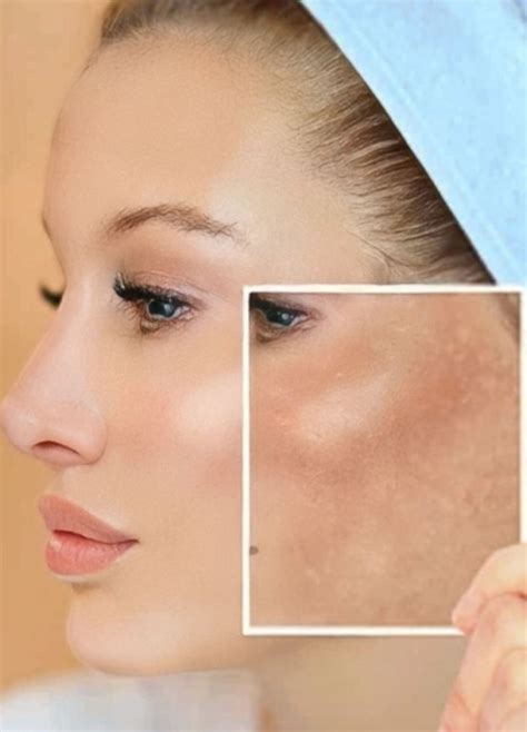 Understanding Hyperpigmentation