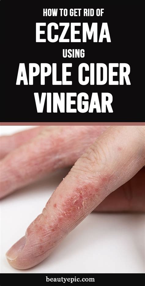 apple cider vinegar eczema     jeremy sanchez blog