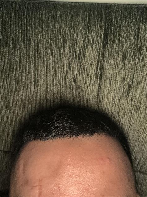 how to get rid of forehead acne 10