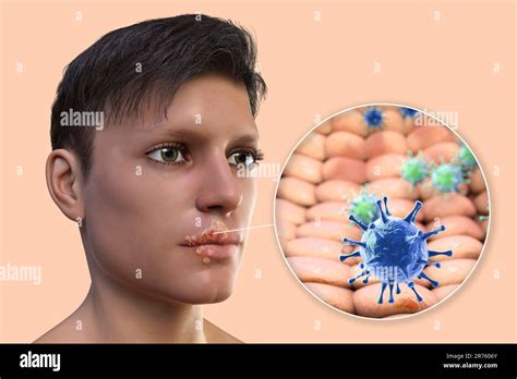 lip cold sore pain  stacy goode blog