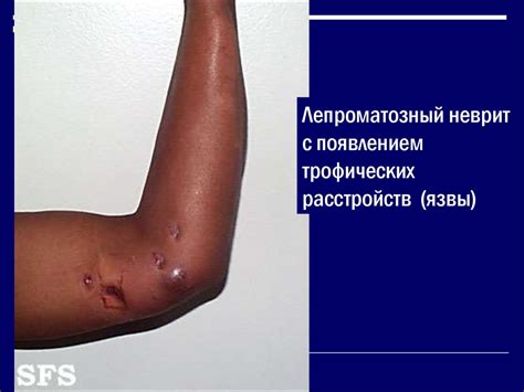 Лепра. Особенности Mycobacterium leprae: - презентация онлайн