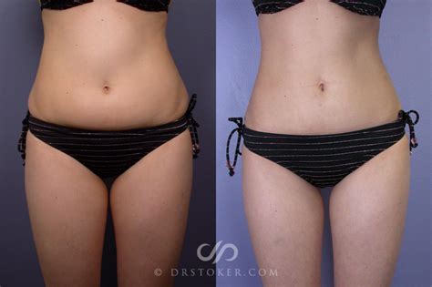 Lipo Light Body Contouring Before And After | Shelly Lighting