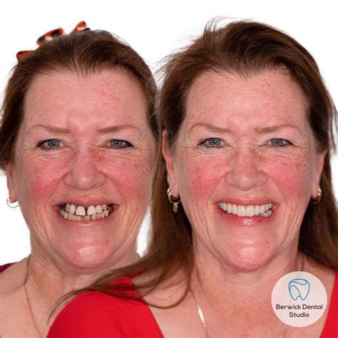 “All on four” Dental Implant method changed her life! – Berwick Dental ...