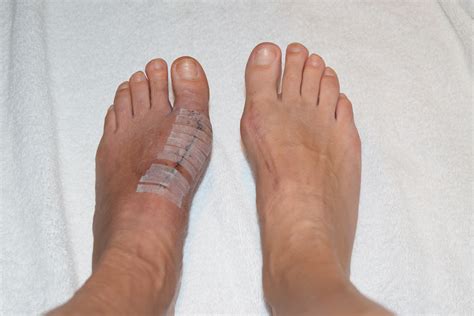 How To Take Shower After Foot Surgery at Jacob Mauldin blog