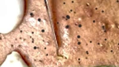 Amazing remove blackheads - Acne Treatment blackheads on the face easy ...