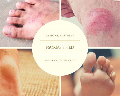 Psoriasis On Hands And Feet