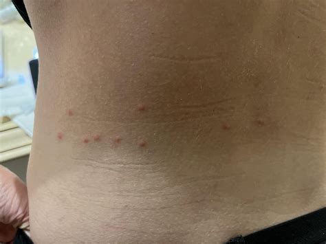Itchy bug bites! What are they?! : r/PuertoRico