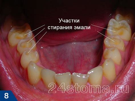 Бруксизм у детей и взрослых – почему ребенок скрипит зубами во сне