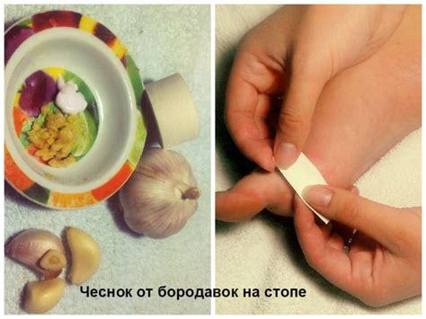 Народные средства от бородавок на пальцах рук - лечение