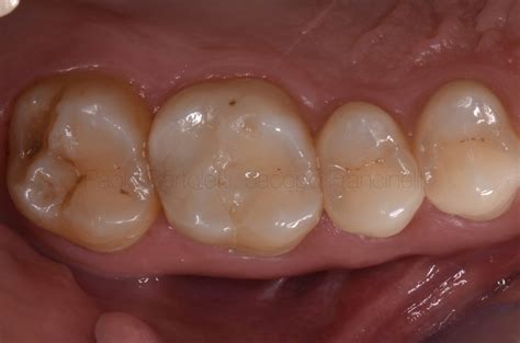 External root resorption: is intentional replantation a real option? A