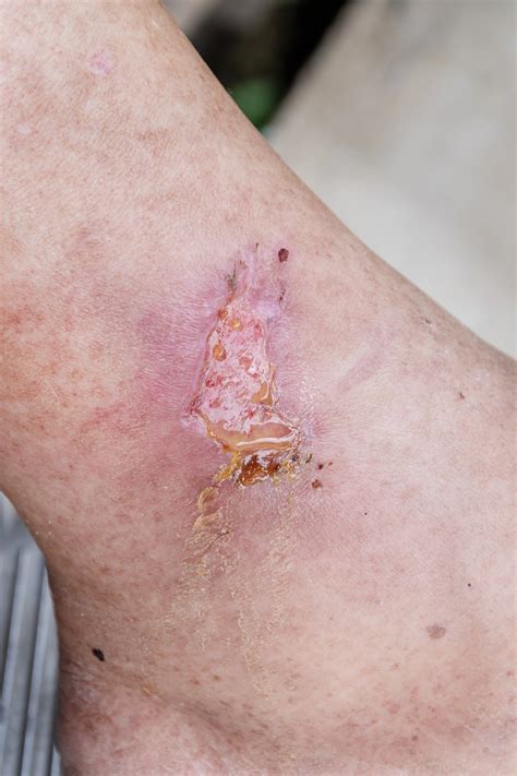 infected wound treatment  raleigh nc wound care nc pllc