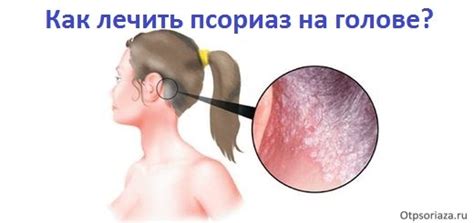 Псориаз кожи головы – лучшее лечение, симптомы и причины