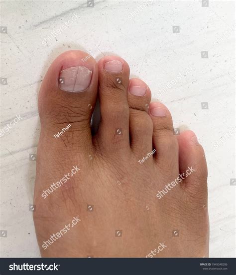 Melanoma Foot: Over 88 Royalty-Free Licensable Stock Photos | Shutterstock