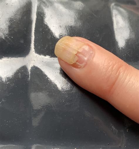 My mother has a fingernail that is coming loose. Should she yank it off ...