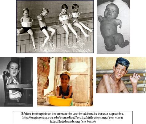 Efeitos Colaterais Da Talidomida - A Terra Média de Claudia: Os Bebês da Talidomida