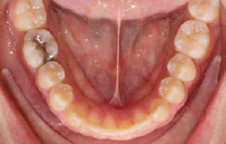 smile gallery    shoresmiles orthodontics