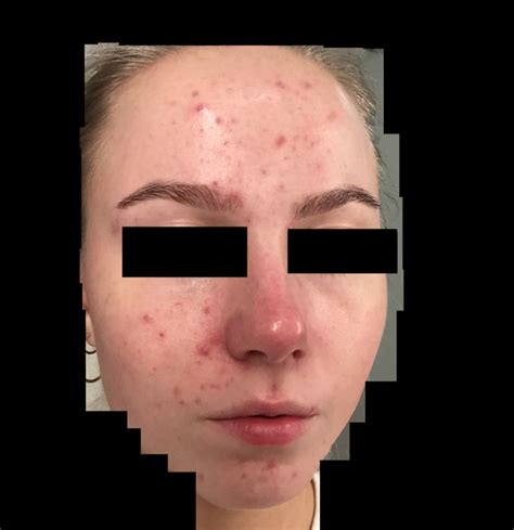 Is this mild, moderate or severe acne? : r/acne