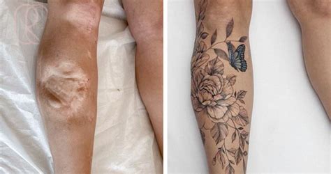 Cicatrizes E Tatuagens - 13 cicatrizes que se tornaram obras de arte através de tatuagens