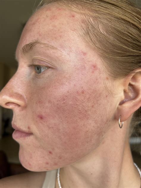 white bumps on face that won't pop 4