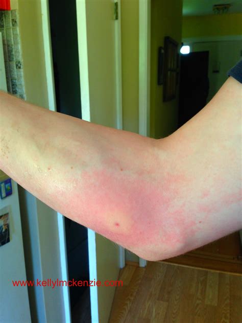 Wasp Sting Allergic Reaction
