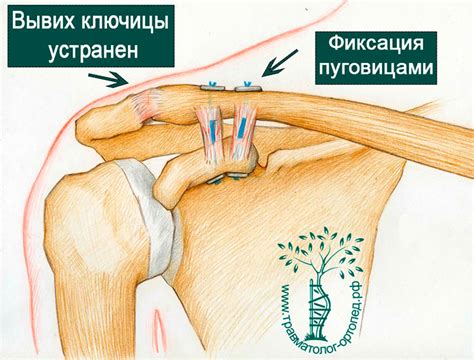 Операция связок плечевого сустава лечение