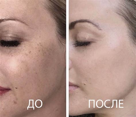 Фототерапия Лица Отзывы Фото — Mixyfotos.ru