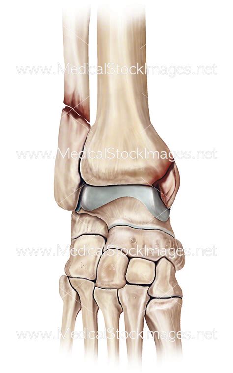 Ankle Fracture – Medical Stock Images Company