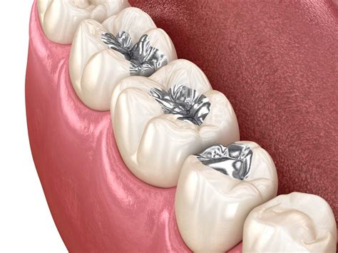 Amalgam Dolgu Nedir? Neden Artık Tercih Edilmiyor? | Dentevim Ağız ve ...